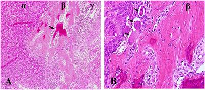 Denosumab in Giant Cell Tumor of Bone: Current Status and Pitfalls